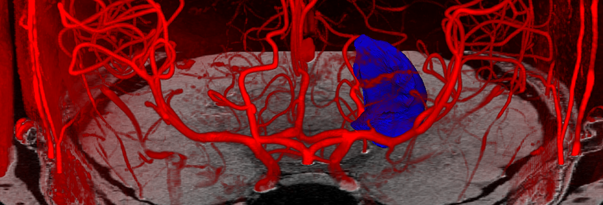 reconstructions of the arteries in the brain