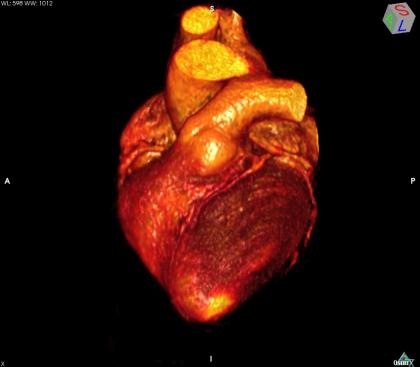 MRI Heart