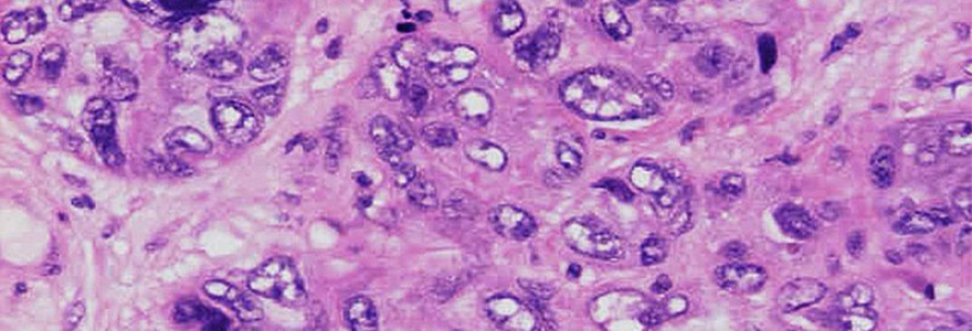 breastcancercells-880x300.jpg