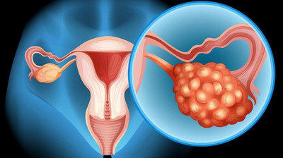 Growing Hope: Using Mini-Tumors to Explore New Combination Treatments for Ovarian Cancer