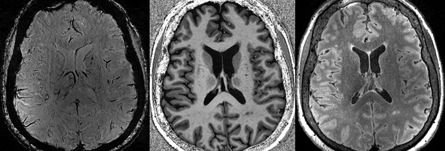 7T MRI scans demonstrating the high level of contrast and resolution that allows researchers to pinpoint tissue damage following COVID-19 illness