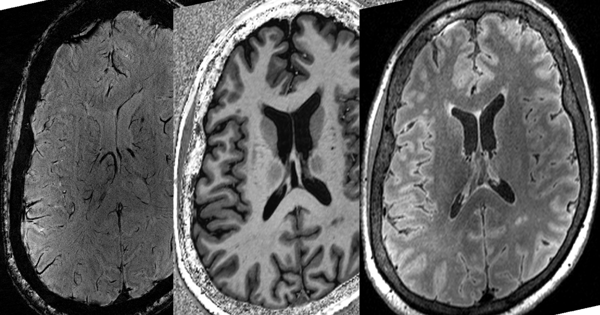 Feature Powerful brain imaging creates new insights on neurological