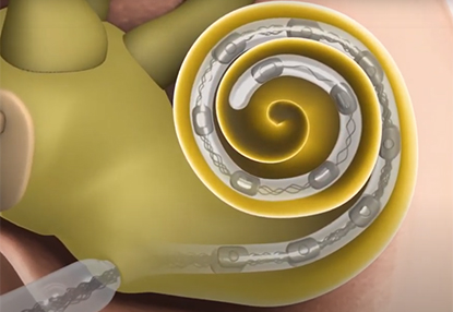 an artist's rendition of a cochlear implant electrode within a cochlea.