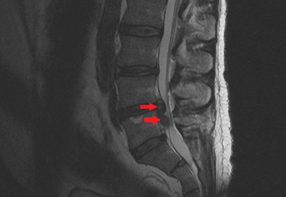 MRI of a disc herniation