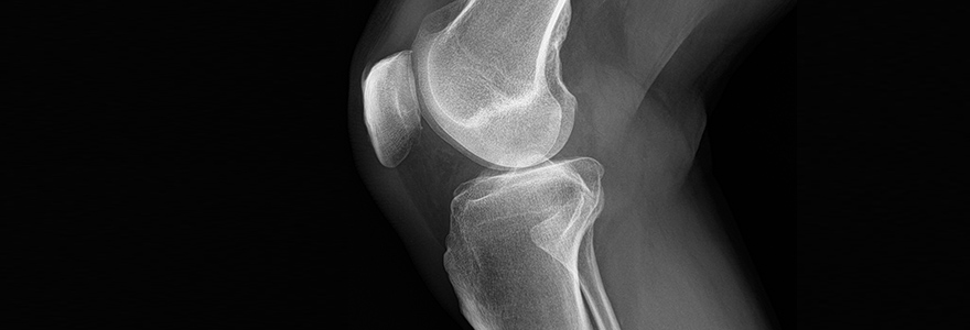 Xray of a kneee joint