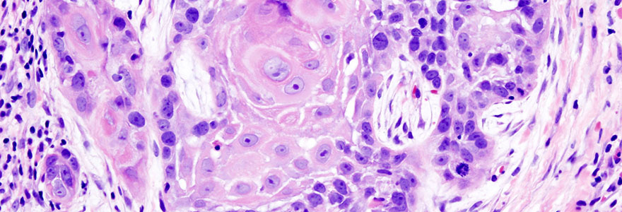 Oral cancer squamous cell carcinoma histopathology