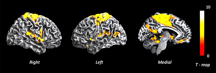 MRI imaging of the brain - shows highlighted areas in yellow where connectivity is increased in patients with psychosis