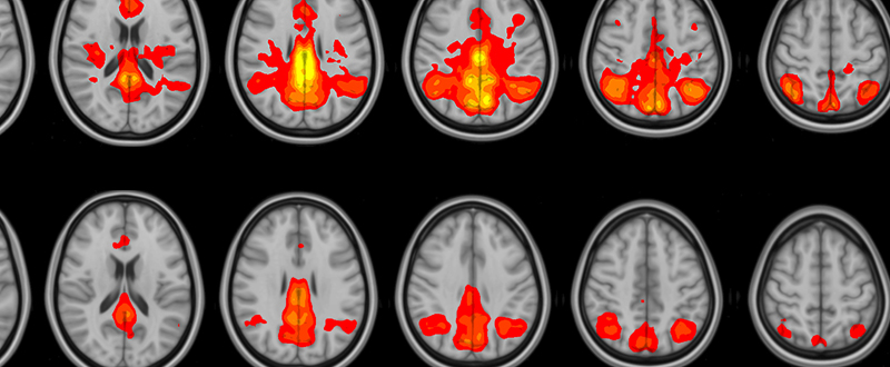 images of brain MRIs with coloured maps indicating changes in teh brain for contact athletes versus non-contact