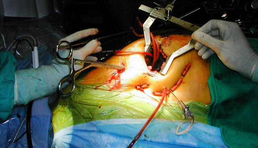 Mini_Invasive_Aortic-Clamp.jpg