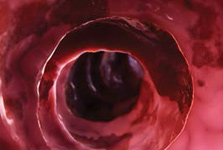 Home-grown hope for people with ulcerative colitis