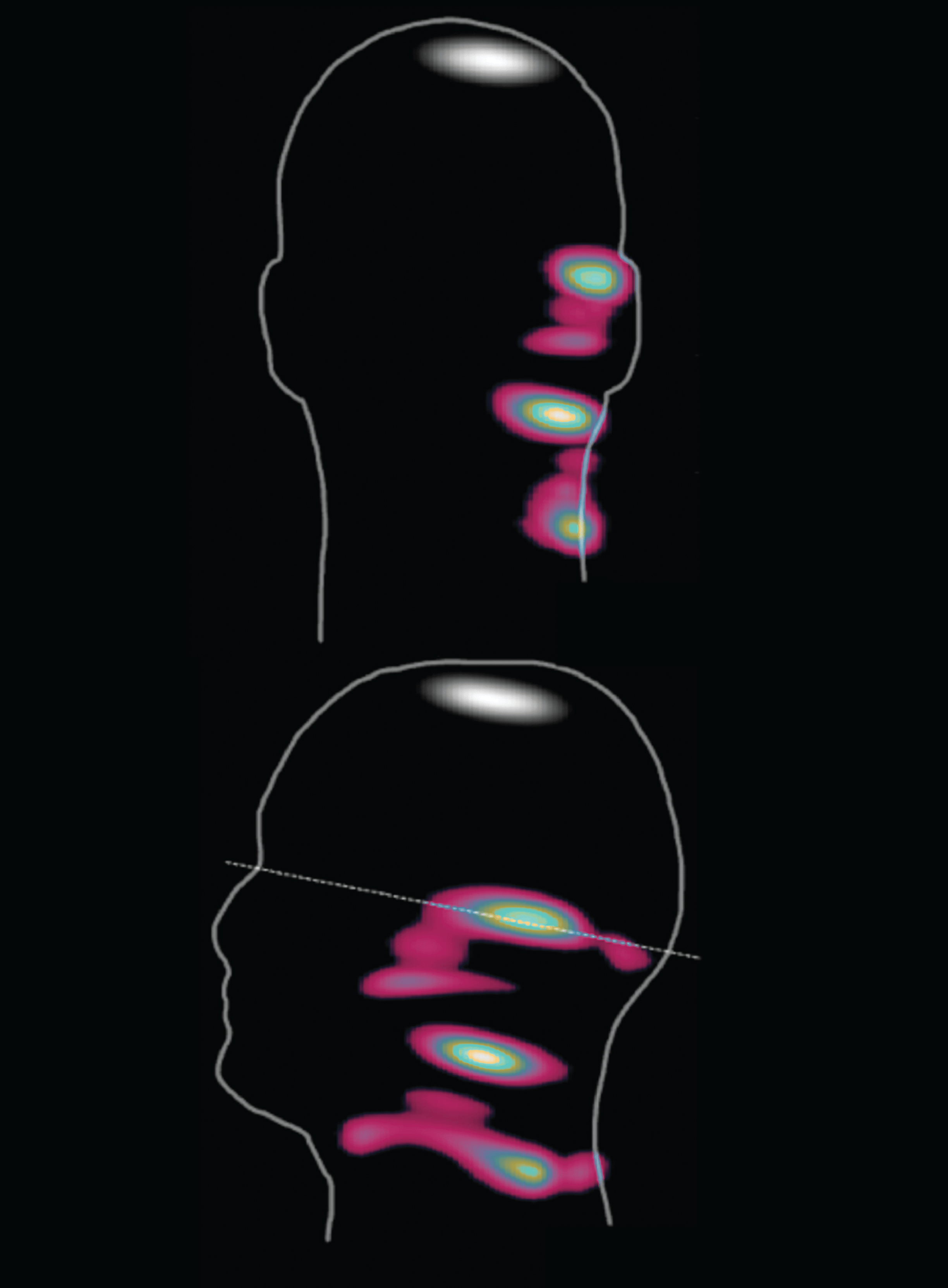 Magnetic particle imaging scan showing iron particle signal from an injection site to lymph nodes, overlaid on a head and neck silhouette