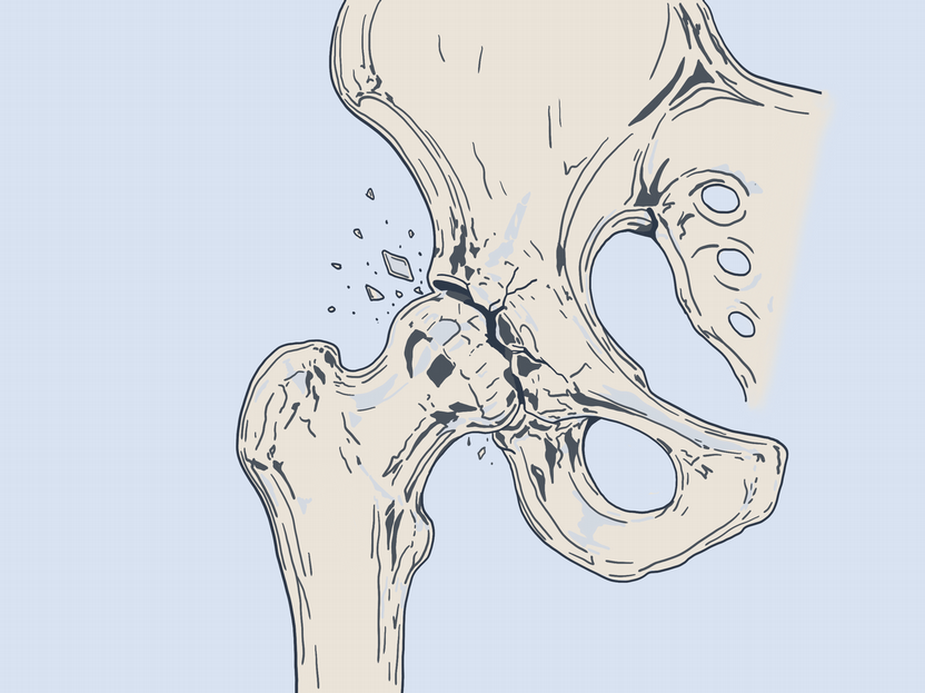 Illustration of a fractured hip joint