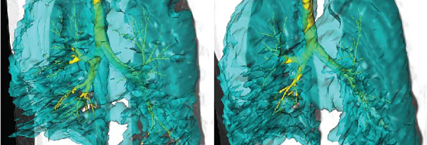 Photograph of two lung images